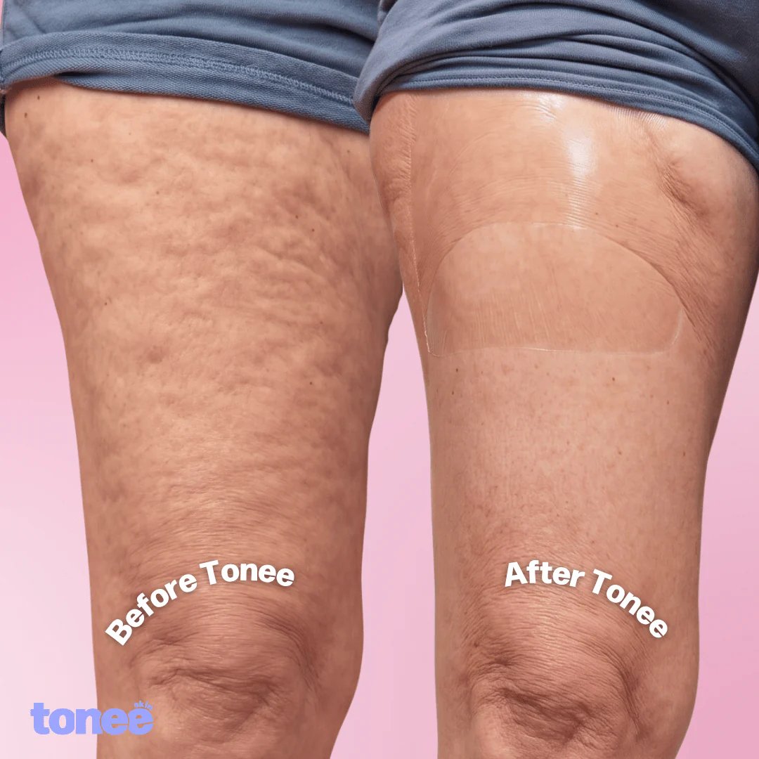 Before and after smoothing tape applied to thigh